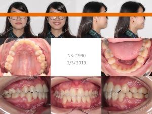 Hình ảnh niềng răng hô, lộn xộn, nhổ răng hỏng tủy thay vì răng số 4 - Ca 8