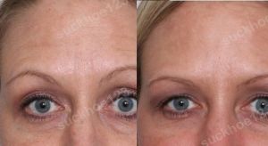 Hình ảnh tiêm Botox trước sau Dr Tâm – ca 45