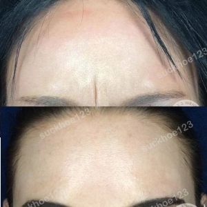 Hình ảnh tiêm Botox trước sau Dr Tâm – ca 50