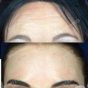 Hình ảnh tiêm Botox trước sau Dr Tâm – ca 50