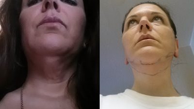 Review căng da cổ, căng da phần dưới của mặt và kết quả sau 3 năm