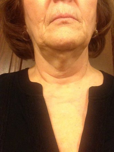 Trẻ hóa ở tuổi 65 với phương pháp căng da cổ/căng da quanh hàm