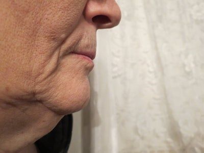 Trẻ hóa ở tuổi 65 với phương pháp căng da cổ/căng da quanh hàm