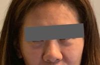 Restylane gây thâm dưới mắt. Có nên tiêm tan không?