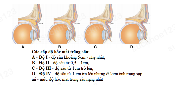 hốc mắt trũng sâu 1