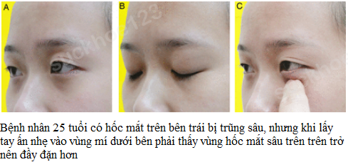 hốc mắt trũng sâu dịch chuyển 1