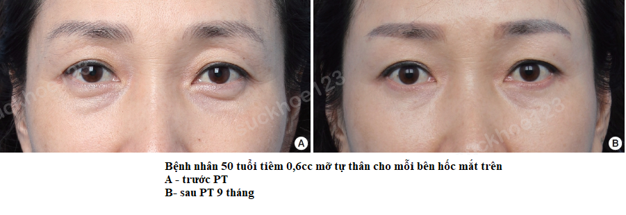 hốc mắt trũng sâu fat transfer 2