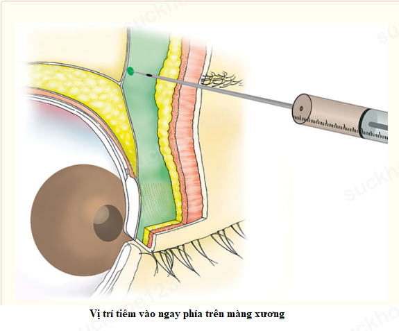 hốc mắt trũng sâu filler 1