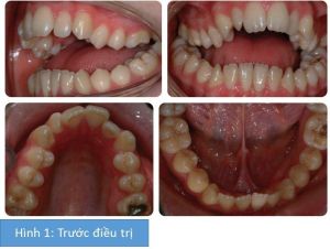 Phân tích case: Phẫu thuật hàm kết hợp niềng răng cho bệnh nhân nữ bị cắn hở 12 mm