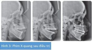 Phân tích case: Phẫu thuật hàm kết hợp niềng răng cho bệnh nhân nữ bị cắn hở 12 mm
