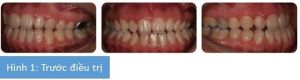 Phân tích case: Niềng răng kết hợp phẫu thuật hàm cho bệnh nhân bị móm và cằm lệch trái