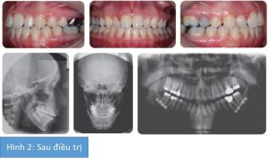 Phân tích case: Niềng răng kết hợp phẫu thuật hàm cho bệnh nhân bị móm và cằm lệch trái