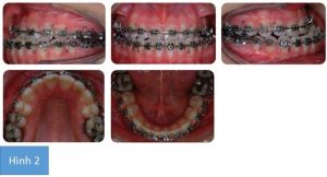 Phân tích case: Niềng răng kết hợp phẫu thuật hàm cho bệnh nhân bị móm, lệch đường giữa, răng chen chúc