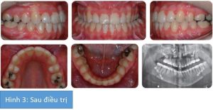 Phân tích case: Niềng răng kết hợp phẫu thuật hàm cho bệnh nhân bị móm, lệch đường giữa, răng chen chúc