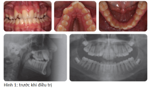 Phân tích case: Niềng răng có dùng nong nhanh hàm trên cho bệnh nhân sai khớp cắn loại I