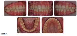Phân tích case: Niềng răng thành công cho bệnh nhân bị hô 2 hàm, có nhổ 4 răng hàm nhỏ