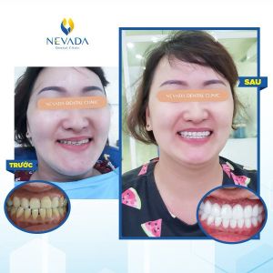 Hình ảnh bọc 16 răng sứ E-max cao cấp của chị Thảo – Ca 7