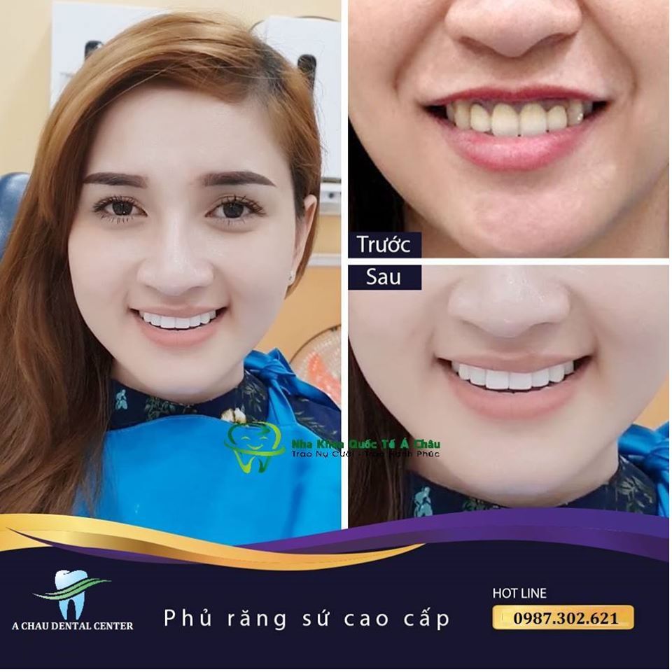 Hình ảnh bọc răng sứ của KH Hoàng Thu Huyền – Nha khoa Quốc tế Á Châu – Ca 15