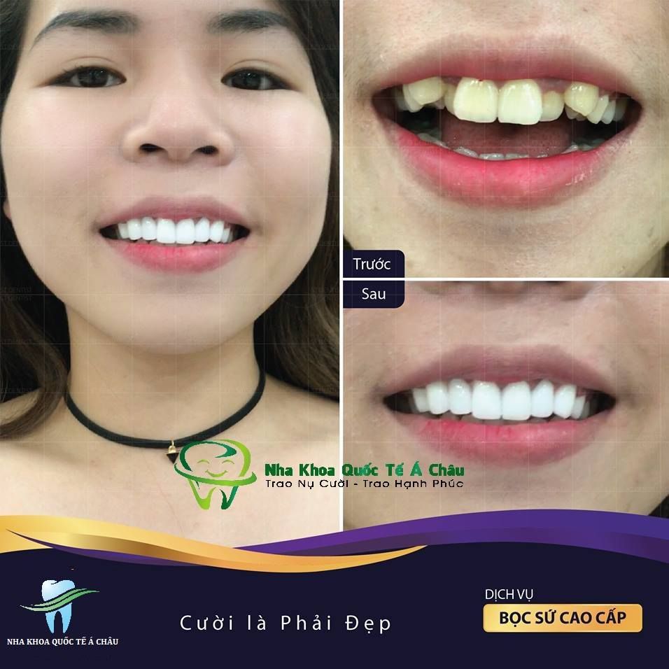 Hình ảnh bọc răng sứ của Kiều Oanh – Nha khoa Quốc tế Á Châu – Ca 20