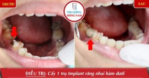 Hình ảnh trồng răng implant của KH X.Cường – Nha khoa Đông Nam – Ca 5