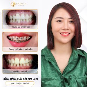 Hình ảnh niềng răng mắc cài của KH Thảo – Nha khoa Thẩm mỹ Quốc tế Jun Dental – Ca 11