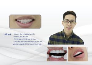 Hình ảnh dán sứ của Đặng Tiến Hoàng – Nha khoa Thẩm mỹ Quốc tế Jun Dental – Ca 31