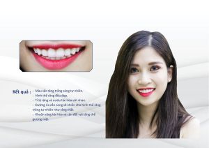 Hình ảnh dán sứ của Trần Thị Thu Quỳnh – Nha khoa Thẩm mỹ Quốc tế Jun Dental – Ca 32