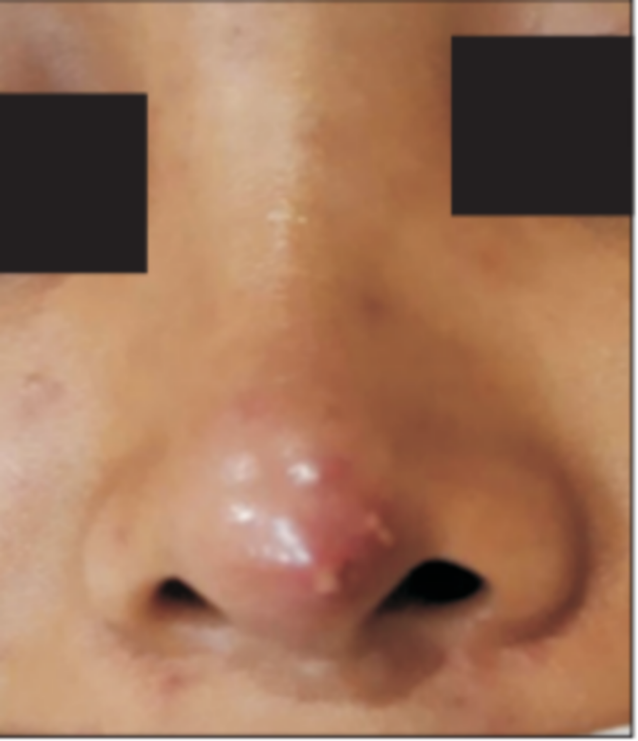 mũi co rút do nhiễm trùng 1