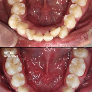 Hình ảnh niềng răng cho BN bị hô, răng chen chúc trong 20 tháng – Nha khoa Peace Dentistry - Ca 13