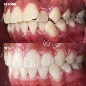 Hình ảnh niềng răng cho BN bị hô, răng chen chúc trong 20 tháng – Nha khoa Peace Dentistry - Ca 13