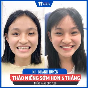 Hình ảnh niềng răng 3D speed của KH Khánh Huyền – Ca 19