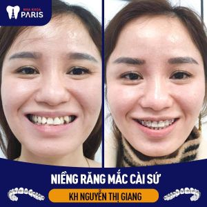 Hình ảnh niềng răng mắc cài sứ của KH Nguyễn Thị Giang – Ca 25
