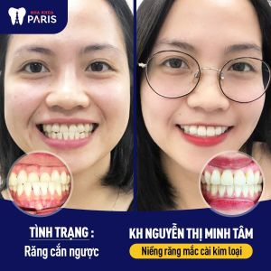 Hình ảnh niềng răng mắc cài kim loại của KH Nguyễn Thị Minh Tâm – Ca 36
