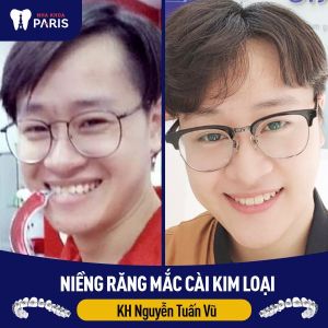 Hình ảnh niềng răng thành công của KH Nguyễn Tuấn Vũ – Ca 37