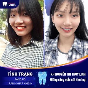 Hình ảnh niềng răng của KH Nguyễn Thị Thùy Linh – Ca 38