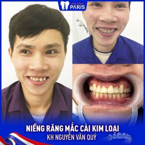 Hình ảnh niềng răng thành công của KH Nguyễn Văn Quý – Ca 48