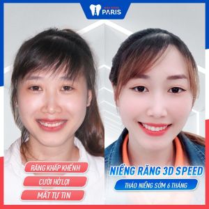 Hình ảnh niềng răng 3d speed của KH Phạm Thị Miền – Ca 7