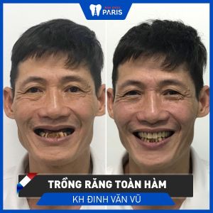 Hình ảnh trồng răng implant của KH Đinh Văn Vũ – Ca 76
