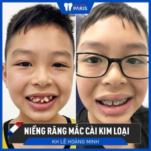 Hình ảnh niềng răng mắc cài kim loại của KH Lê Hoàng Minh – Ca 78