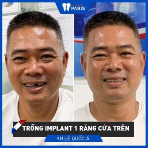 Hình ảnh trồng răng implant của KH Lê Quốc Ái - Ca 86