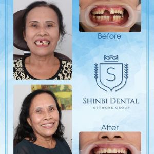 Hình ảnh trồng răng implant của KH Nguyễn Thanh Tịch – Viện CN Nha khoa Thẩm mỹ Shinbi – Ca 4