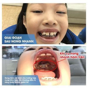 Hình ảnh niềng răng mắc cài của KH Lưu Khánh Chi – Nha khoa Smile one – Ca 11