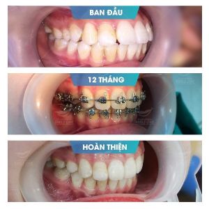 Hình ảnh niềng răng mắc cài của Trần Khánh Chi – Nha khoa Smile one – Ca 3