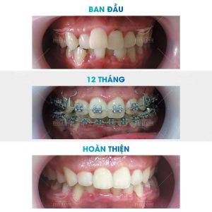 Hình ảnh niềng răng mắc cài của bạn Giang – Nha khoa Smile one – Ca 4