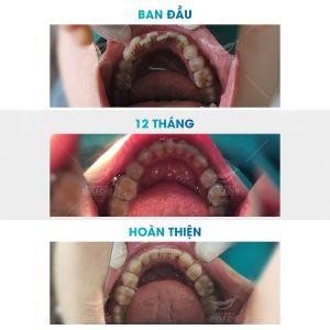 Hình ảnh niềng răng mắc cài của bạn Giang – Nha khoa Smile one – Ca 4
