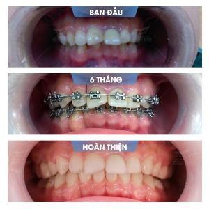Hình ảnh niềng răng mắc cài của KH Anh Tú – Nha khoa Smile one – Ca 6