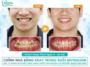 Hình ảnh niềng răng invisalign của KH Phạm Ngọc H – Nha khoa Sentosa – Ca 1