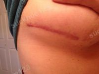 Bao lâu thì có thể phẫu thuật sửa sẹo lần hai sau treo ngực sa trễ?