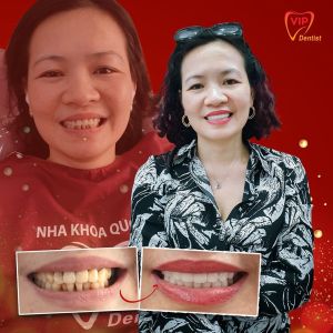 Hình ảnh bọc răng sứ - Nha khoa Quốc tế Vip Dentist – Ca 20