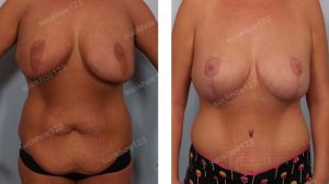 Combo thu nhỏ ngực & tạo hình thành bụng và hút mỡ nhiều vùng, nữ 31 tuổi đã từng nâng ngực hỏng - ca 38